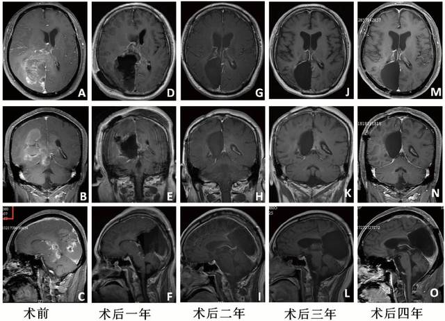 贝伐珠单抗可以报销吗_贝伐珠单抗是靶向药吗_贝伐单抗是否能用于胶质瘤