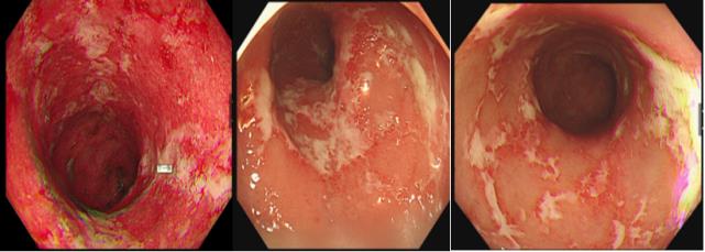 肠炎粘液和肠癌粘液图片