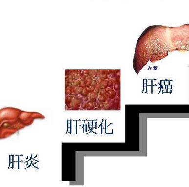 肝癌的15个征兆图片