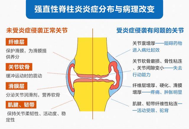 强直性脊柱炎6个地方疼_强直性脊柱炎脊柱疼痛_强直性脊柱炎脊柱痛怎么办