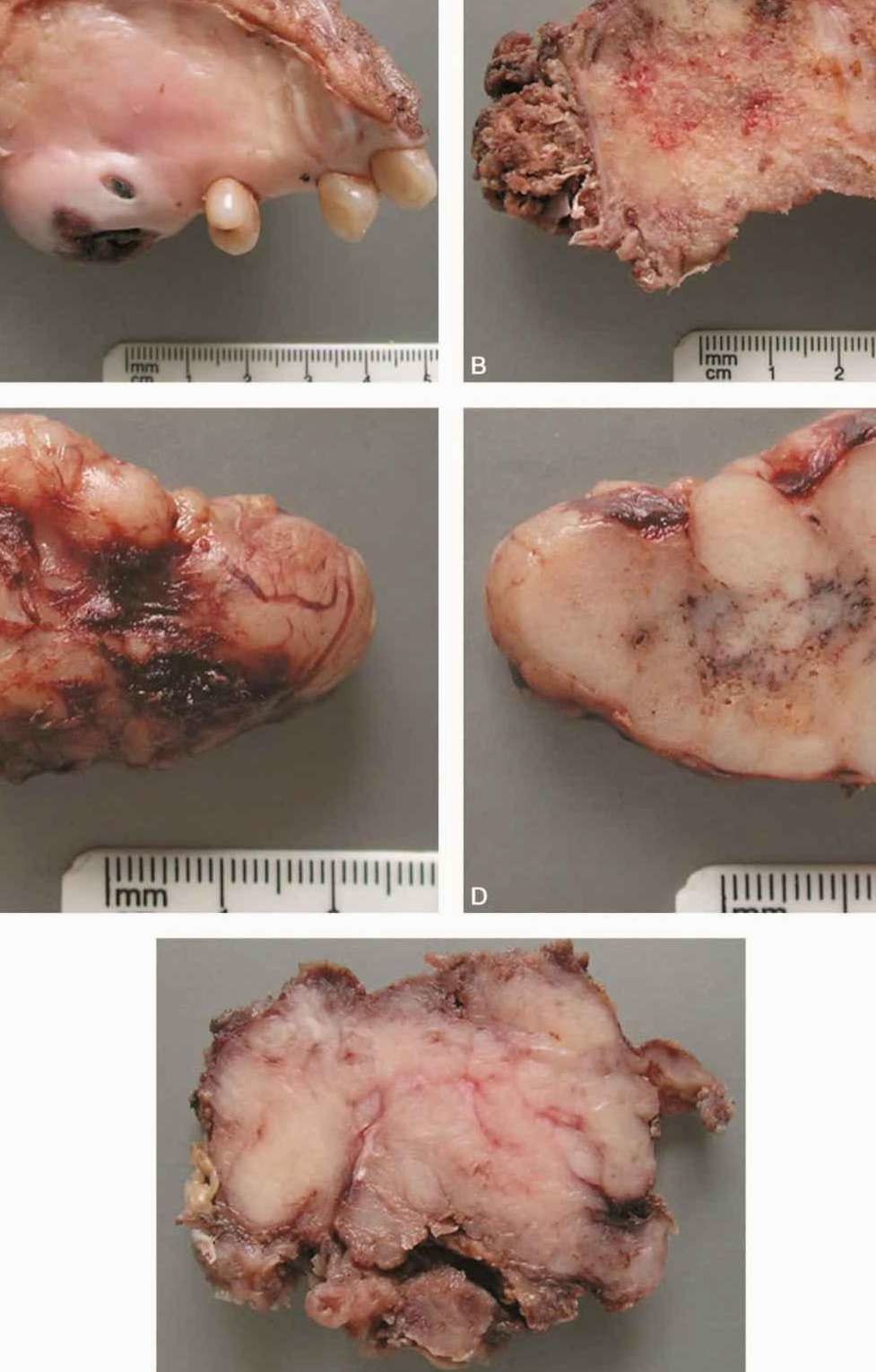 腺样腺样囊性癌做腮腺全切的主要手段是什么?