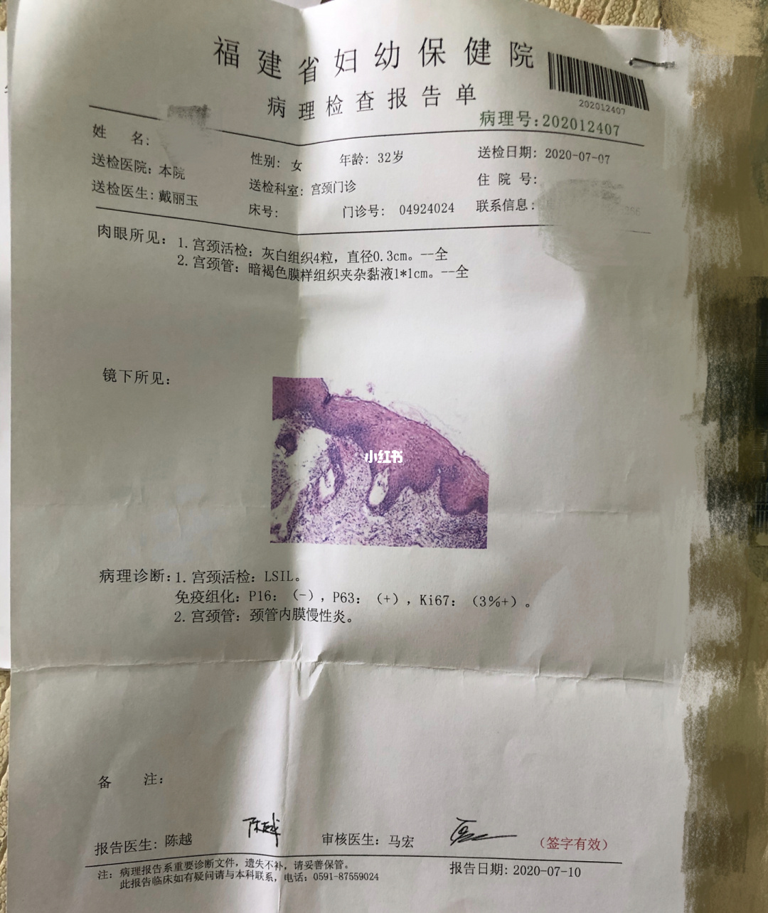 貝伐珠單抗治療複發性宮頸癌_貝伐珠單抗價格_貝伐單抗對腦轉移癌有效