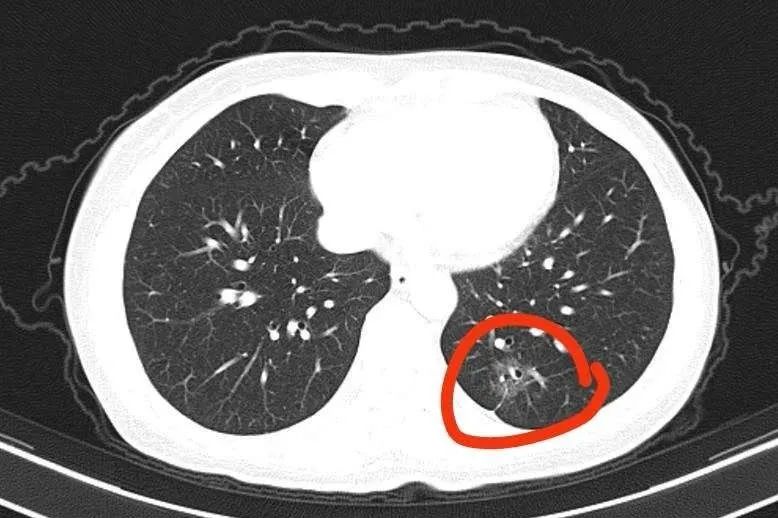 肺鳞癌属于肺癌的一种具体是什么可以治疗吗