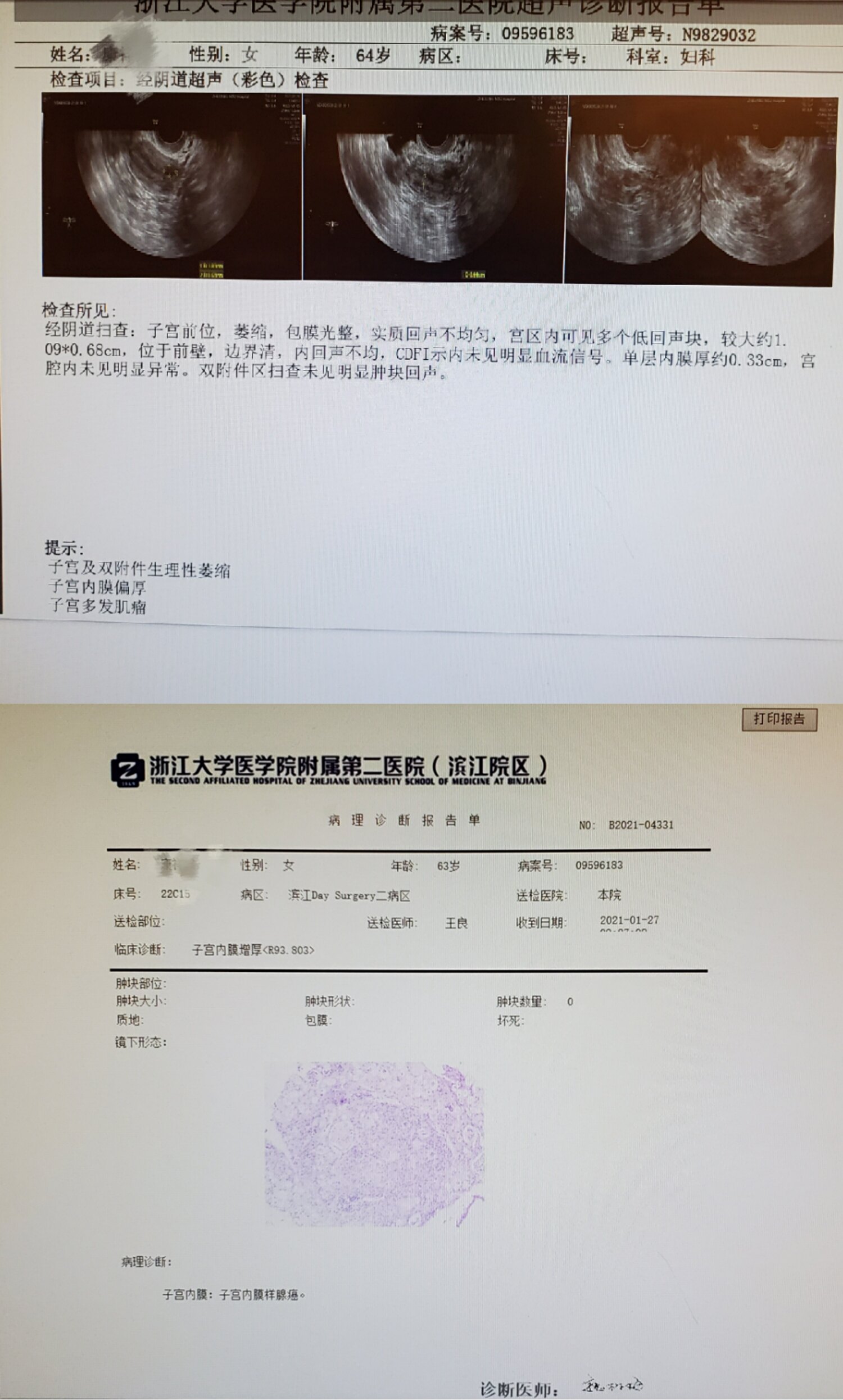 子宫内膜癌能治愈吗图片