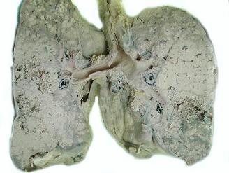 外显子跳跃突变常见于三类病人肺癌患者的突变基因(组图)
