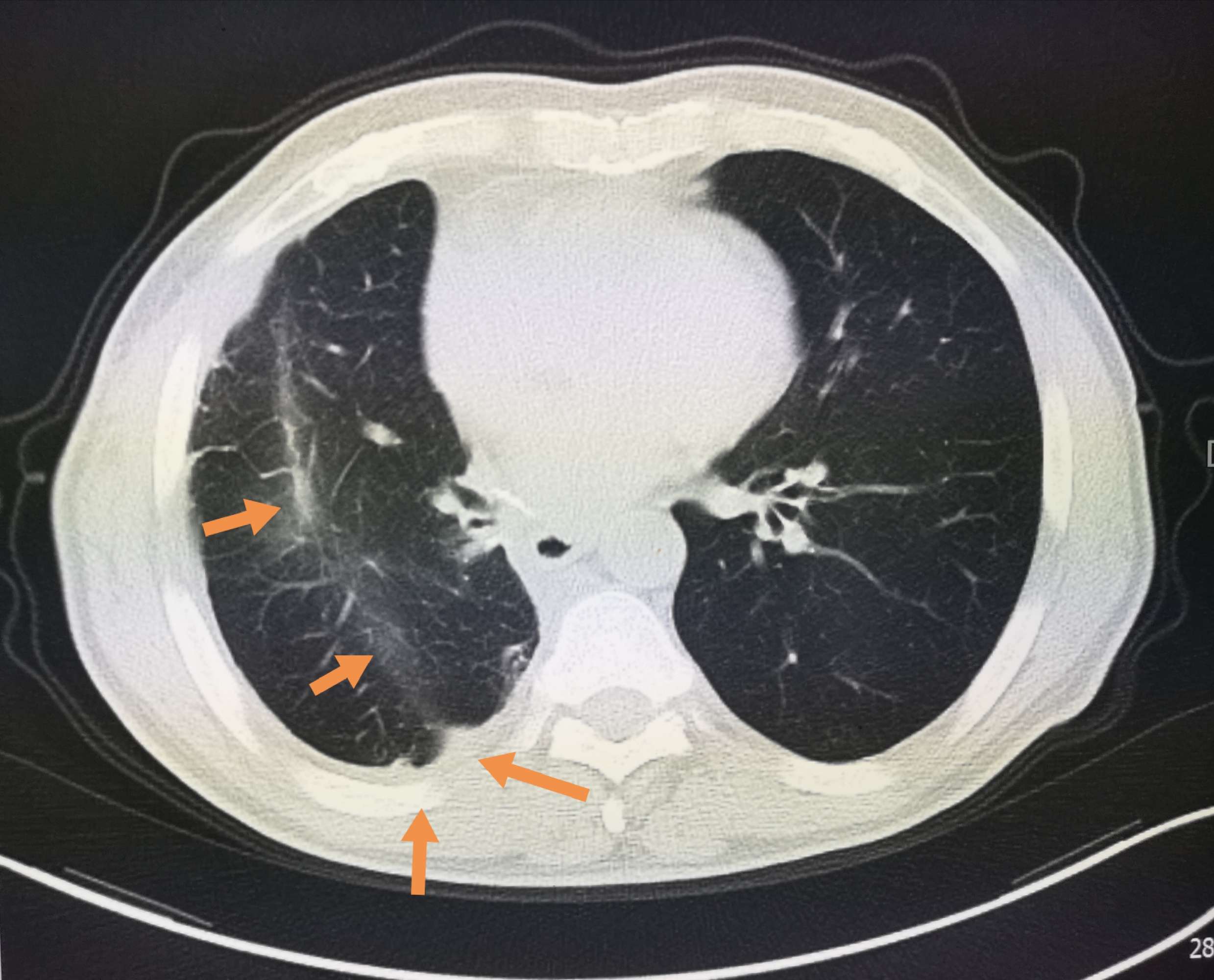 浸润性肺腺癌图片图片